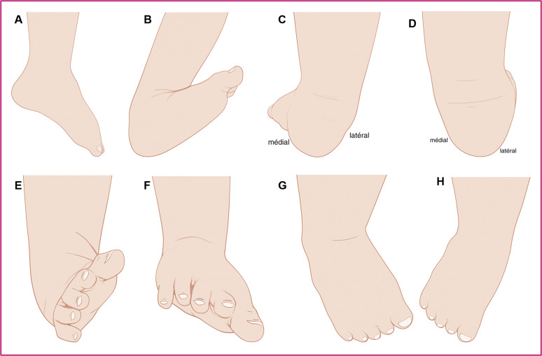 Rééducation kinésithérapique pour le pied bot du bébé