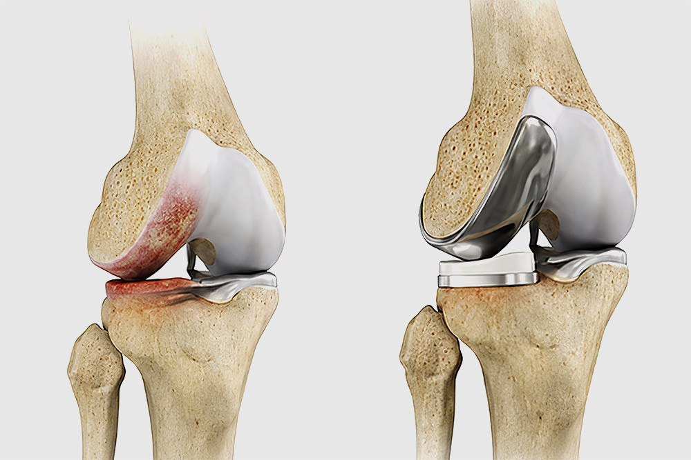 Rééducation orthopédique pour prothèse de genou (PTG)