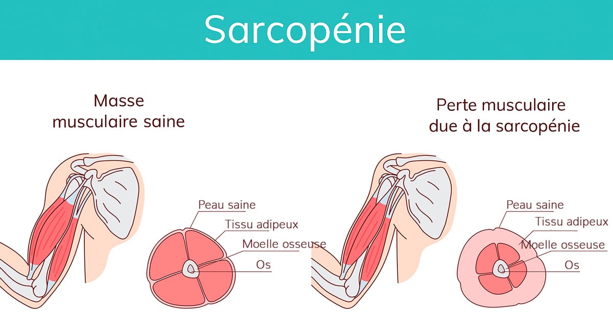 Kiné pour lutter contre la sarcopénie et la fonte musculaire